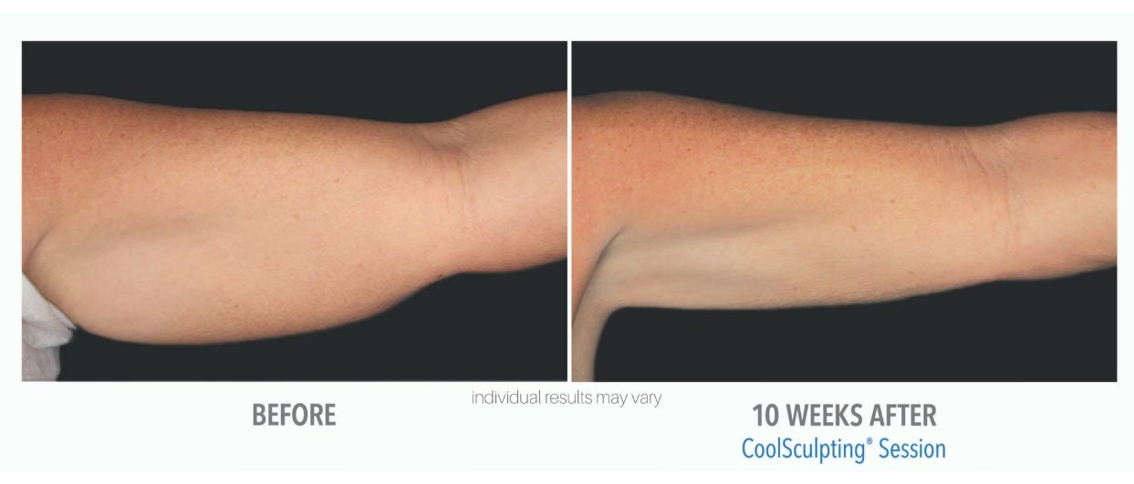 Sculpting a Smaller Waist with CoolSculpting Before & After Photos New  Jersey - Reflections Center