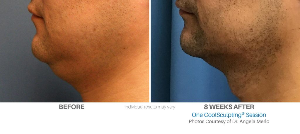 Under-chin-before-after-coolsculpting-session - Best Reflections